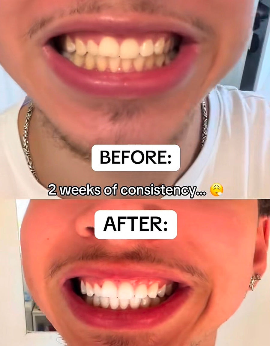 ASCEND 3D CHARCOAL WHITENING STRIPS™